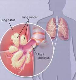 Ung thư phổi - một nguyên nhân gây ho ra máu.